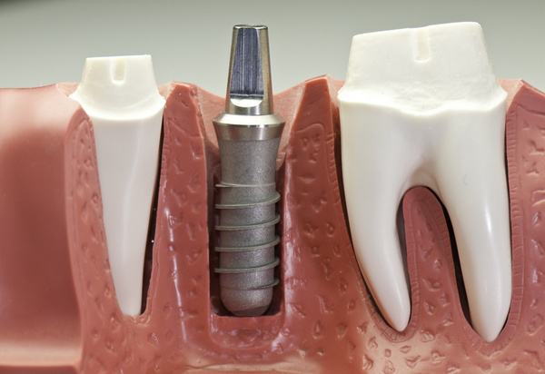 Dental implant failure