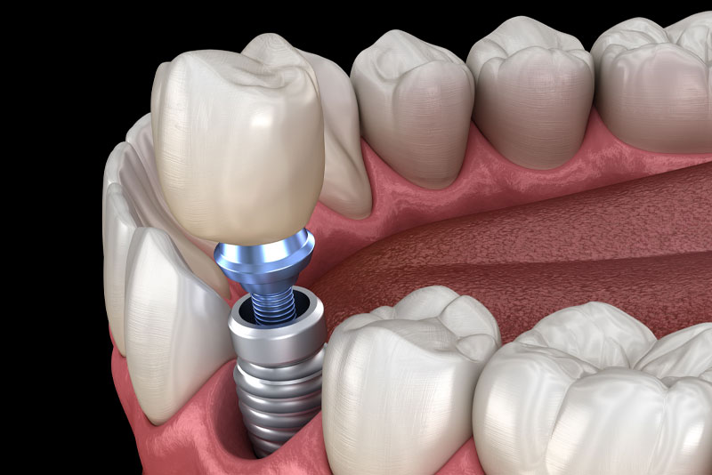 Tooth Transplants: What It Is and Is It Right for You?