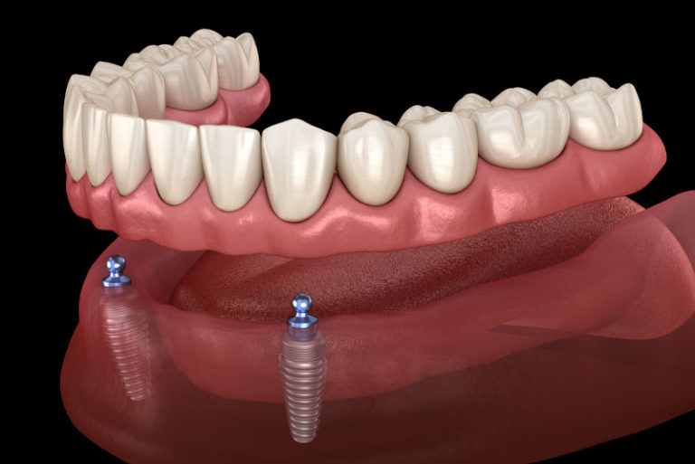 Dental Implants Coventry, RI Dentist & Dental Implants