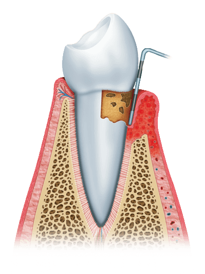 gum disease graphic stage 2