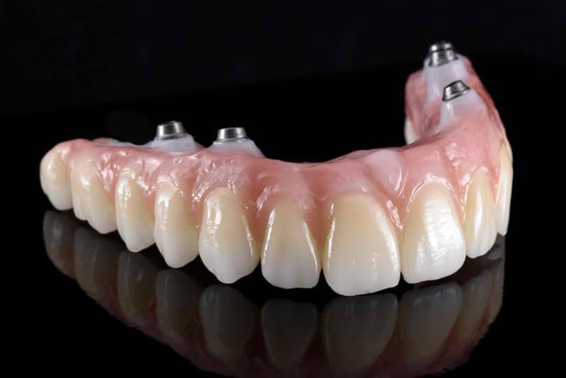 an image of a zirconia full mouth prosthesis with dental implants in them. it can be successfully used for a zirconia fixed bridge procedure.