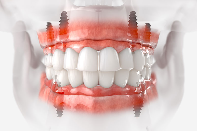 a upper and lower arch full mouth dental implant model that can be shown to patients who are looking to restore their smile with full mouth dental implants after getting tooth extractions.