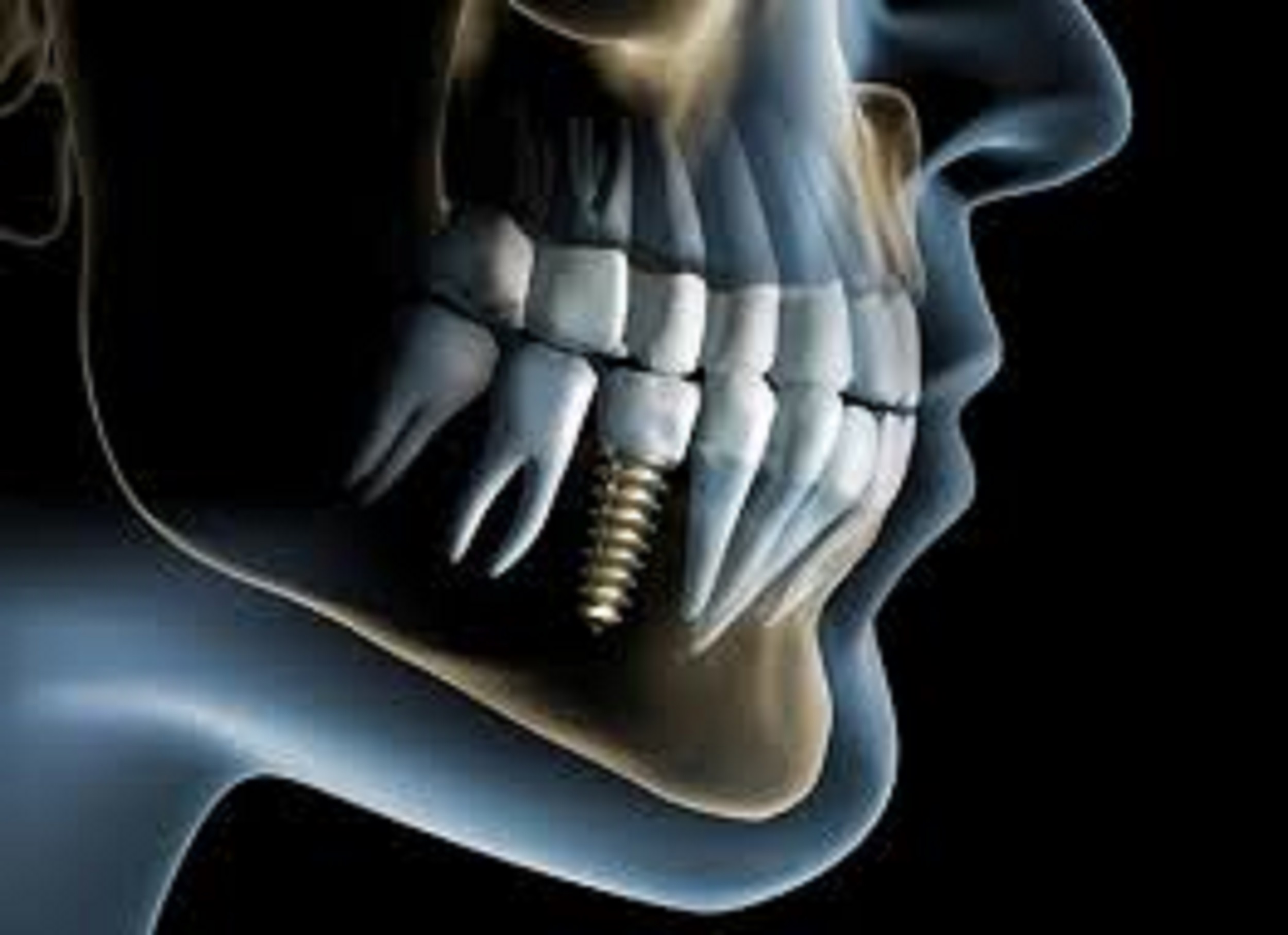 An image of a x ray of a dental implant.