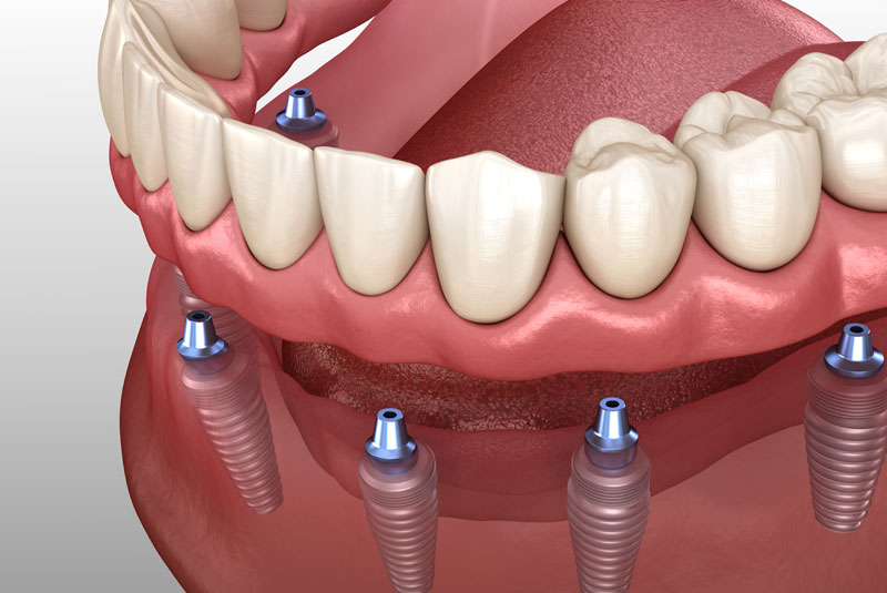 Will Implant Supported Dentures Give Me A More Stable Smile Than Traditional Dentures?