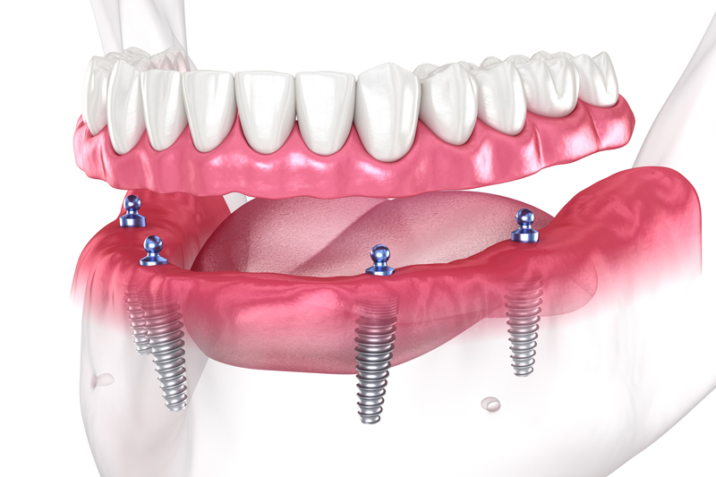 Is There A Difference Between A Temporary Prosthesis And A Final Prosthesis?