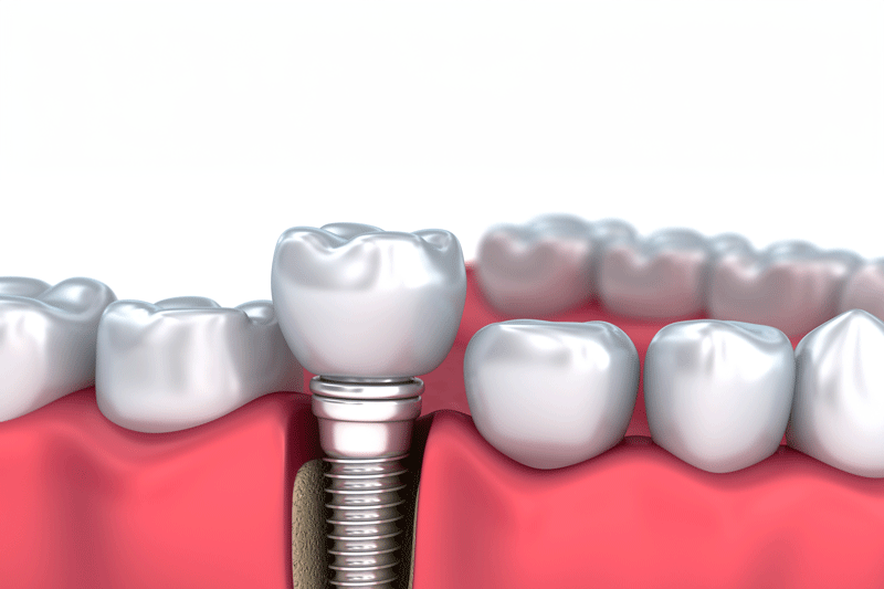 Should I Get Treated With Dental Implants After Tooth Extractions?