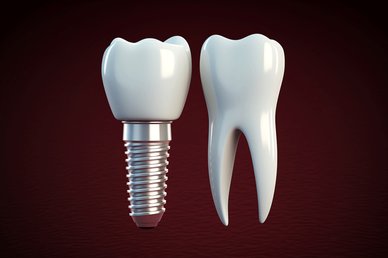 What Are The Parts That Compose A Dental Implant In Coventry, RI?
