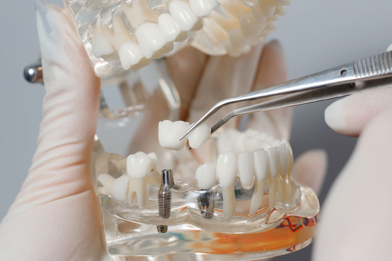 Why Can’t I Taste With Dentures, But Can With Dental Implants?