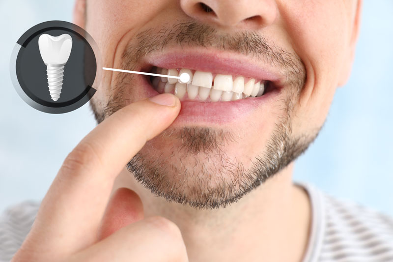 The image shows a close-up of a smiling person's lower face, highlighting their teeth. A finger is pointing to one of the teeth, and there is an inset graphic of a dental implant next to the area being pointed at.