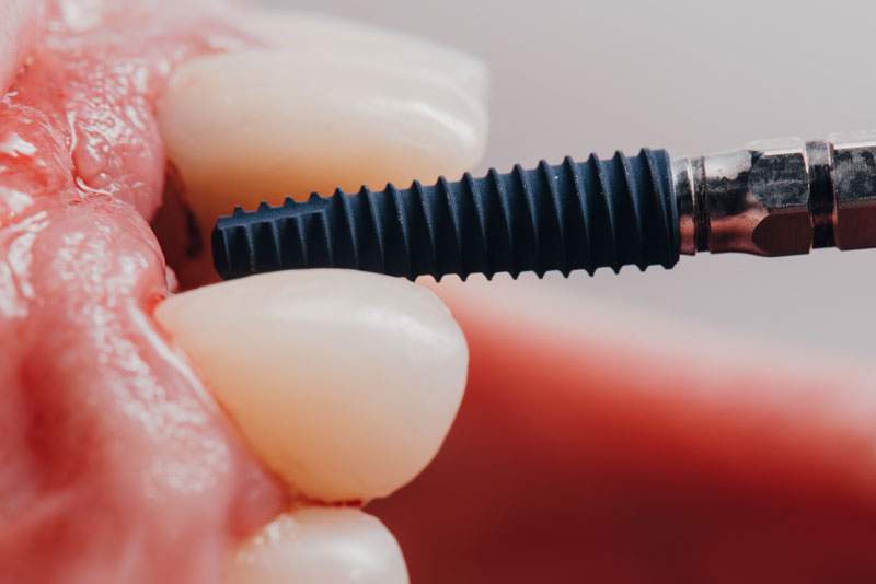 Understanding Your Abutment on Implant: A Comprehensive Guide to Dental Implants Success