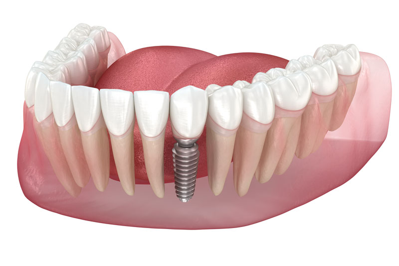 Dental Implants: Your Top Questions Answered By RI’s Top Implant Expert