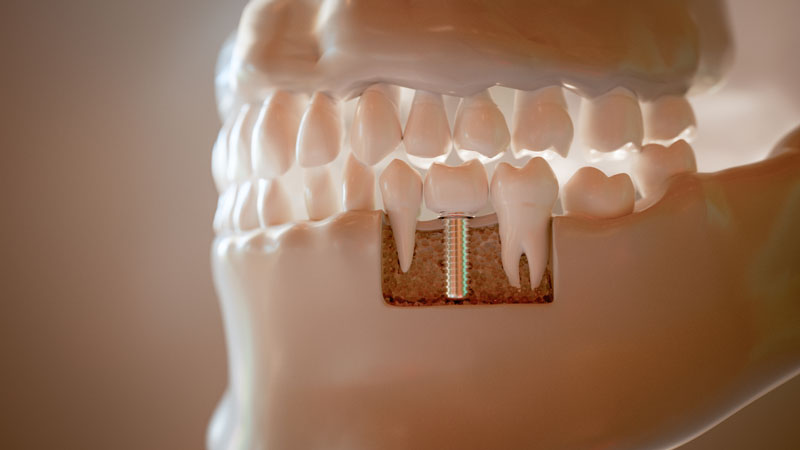 Your Guide To Understanding The Definition Of Dental Implants